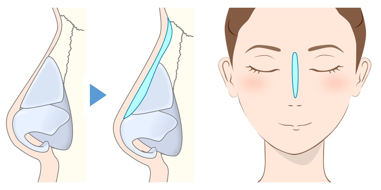 鼻プロテーゼは鼻骨・鼻軟骨の表面に挿入・固定します