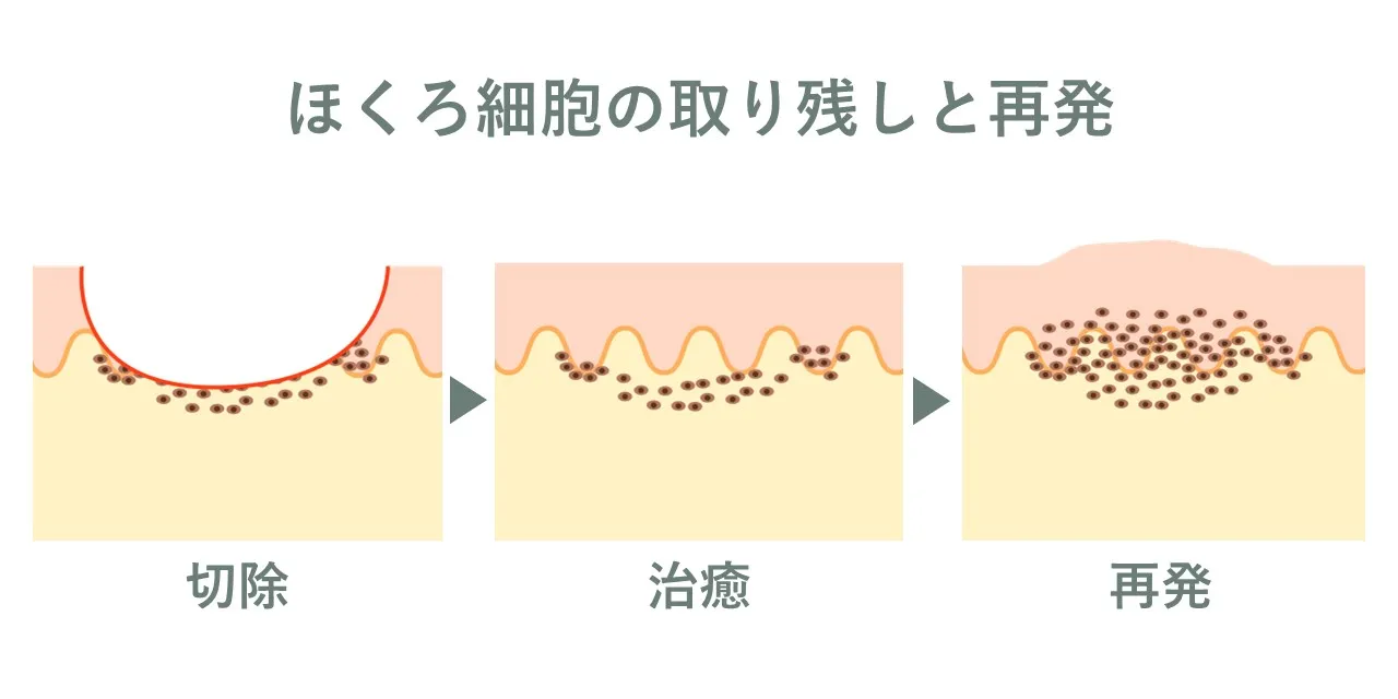 ホクロの取り残しと再発を表す病理イラスト