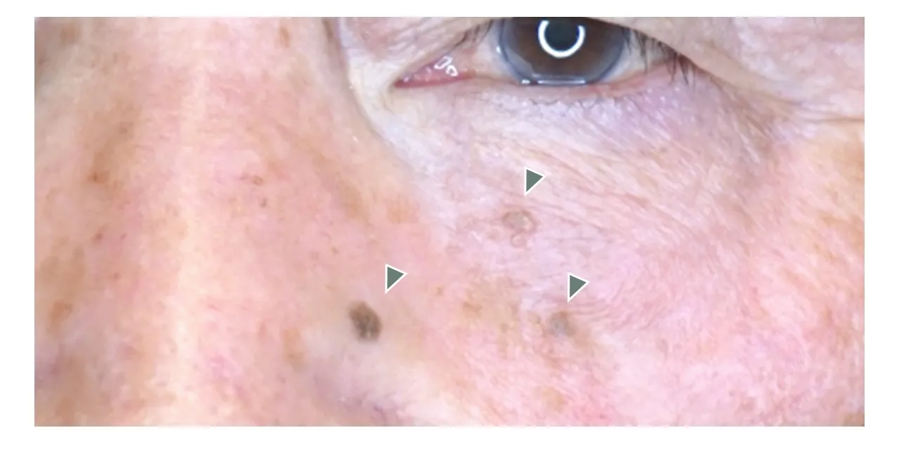 目もとの脂漏性角化症の写真