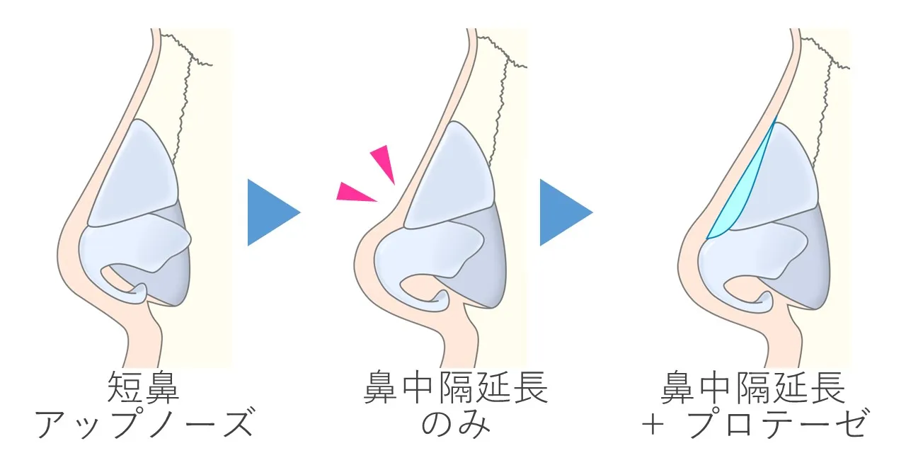 鼻中隔延長術における鼻プロテーゼの必要性