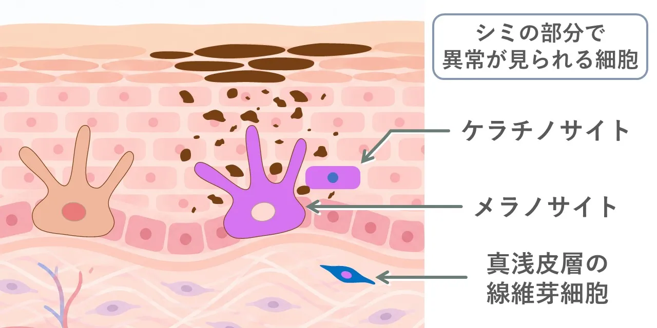 シミの根本的な原因は、肌の細胞（ケラチノサイト、メラノサイト、線維芽細胞）が光老化などにより遺伝子に異常をきたすことで、その結果局所でメラニンが生成されやすくなります