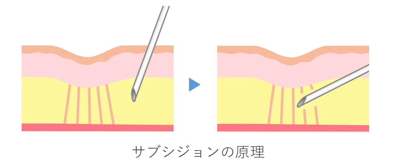 サブシジョンの原理。皮下の線維組織を針先で切り、肌のへこみを改善しているところ