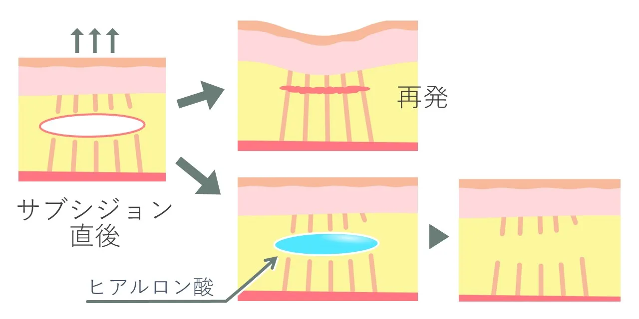 サブシジョンの流れ。ヒアルロン酸注入による再癒着を防ぐ仕組み