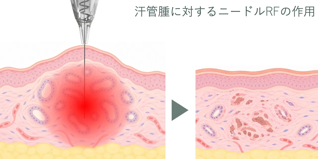 汗管腫に対するニードルRFの作用イメージ