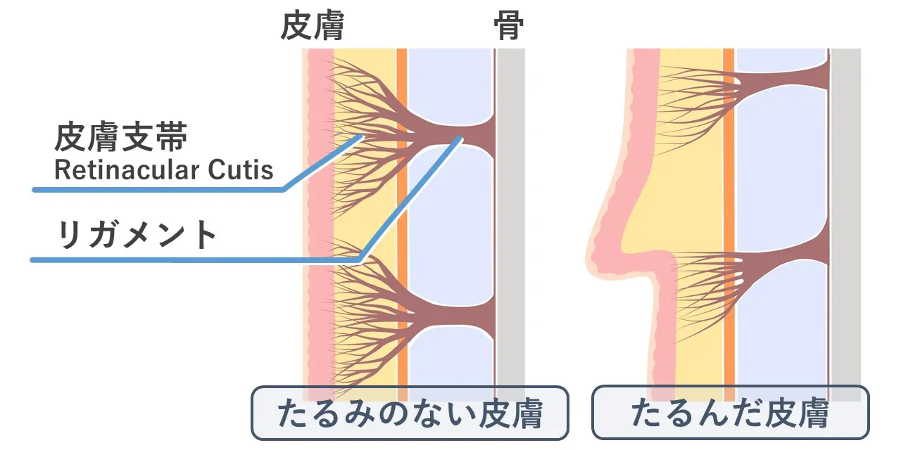 たるみのない肌とたるんだ肌の皮膚支帯の比較