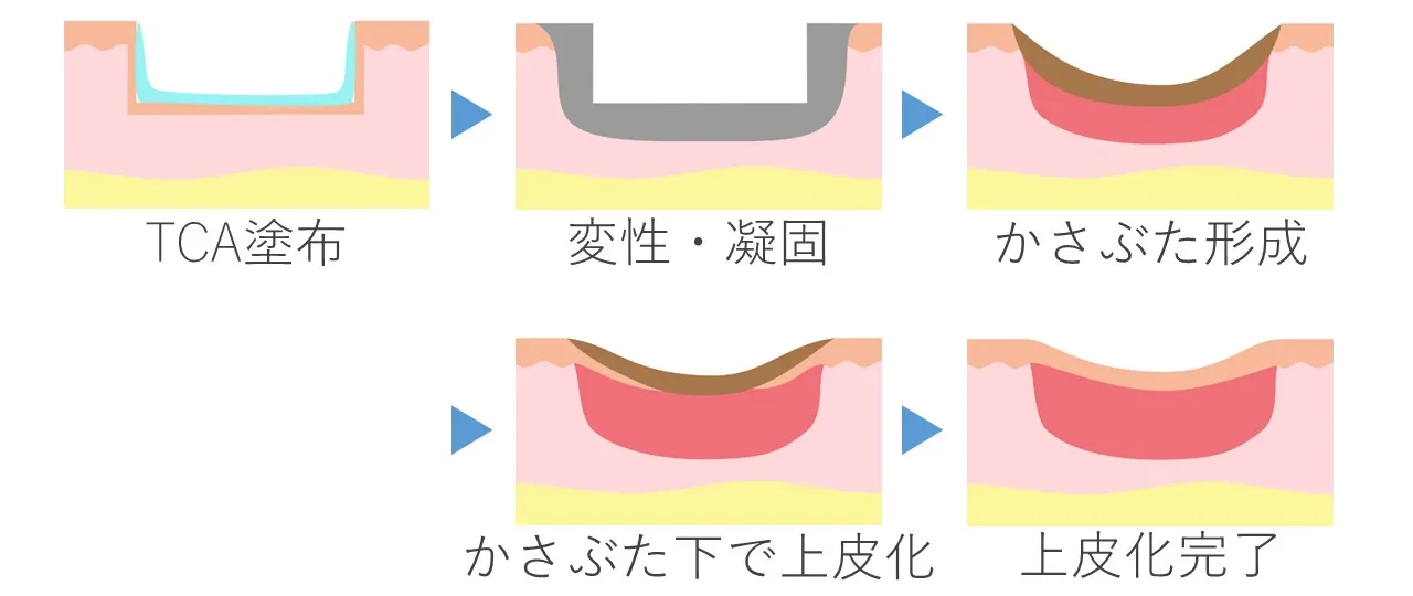 TCAクロスの原理と経時変化