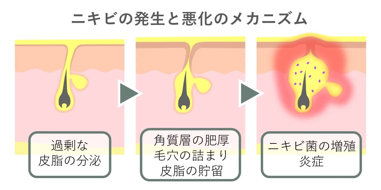 ニキビの発生と悪化のメカニズムを示した図