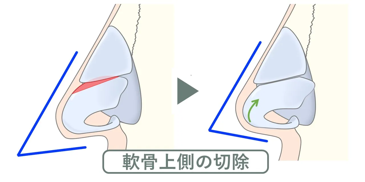 鼻尖形成術による魔女鼻（矢印鼻）の修正｜鼻翼軟骨上部の切除による矯正のイメージ