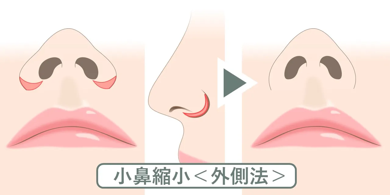 小鼻縮小術の外側法は小鼻自体を小さくする手術です