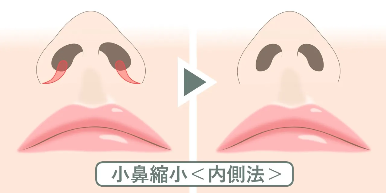 小鼻縮小術の内側法は、鼻の穴を小さくする手術です。