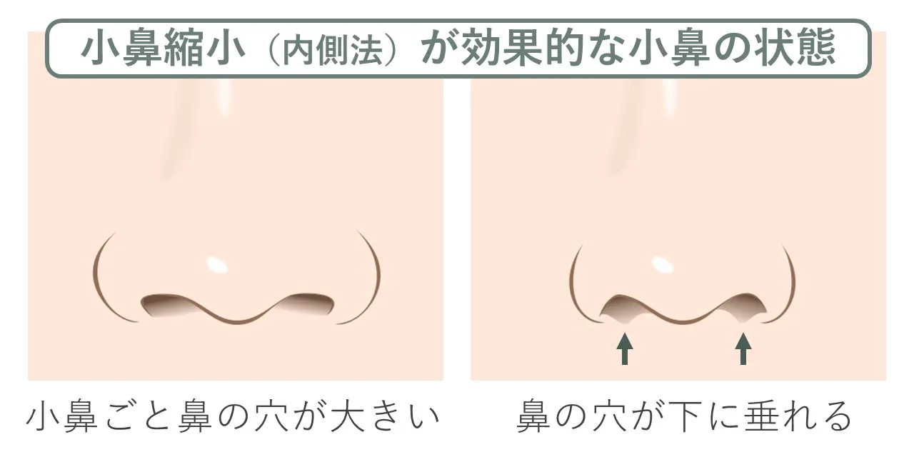 小鼻縮小術の内側法は、鼻の穴が大きい場合や、鼻の穴が垂れたように目立つ場合に効果的です