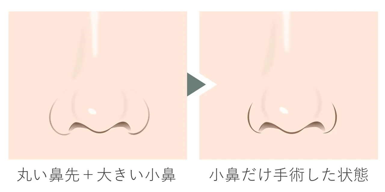 小鼻と鼻尖がともに大きい場合、小鼻縮小の術後に鼻先の大きさが際立つようになります。