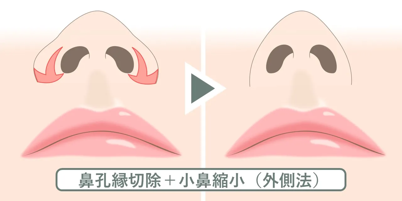 鼻孔縁切除と小鼻縮小を同時に行う際の皮膚切除範囲