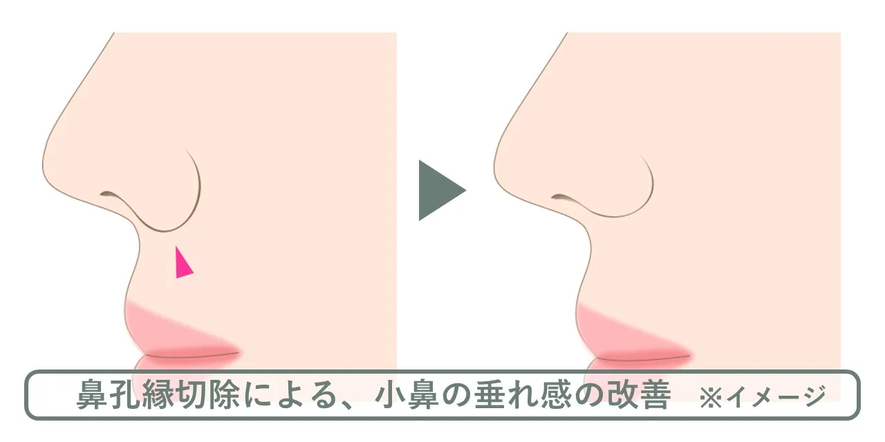 鼻孔縁切除術の効果のイメージ