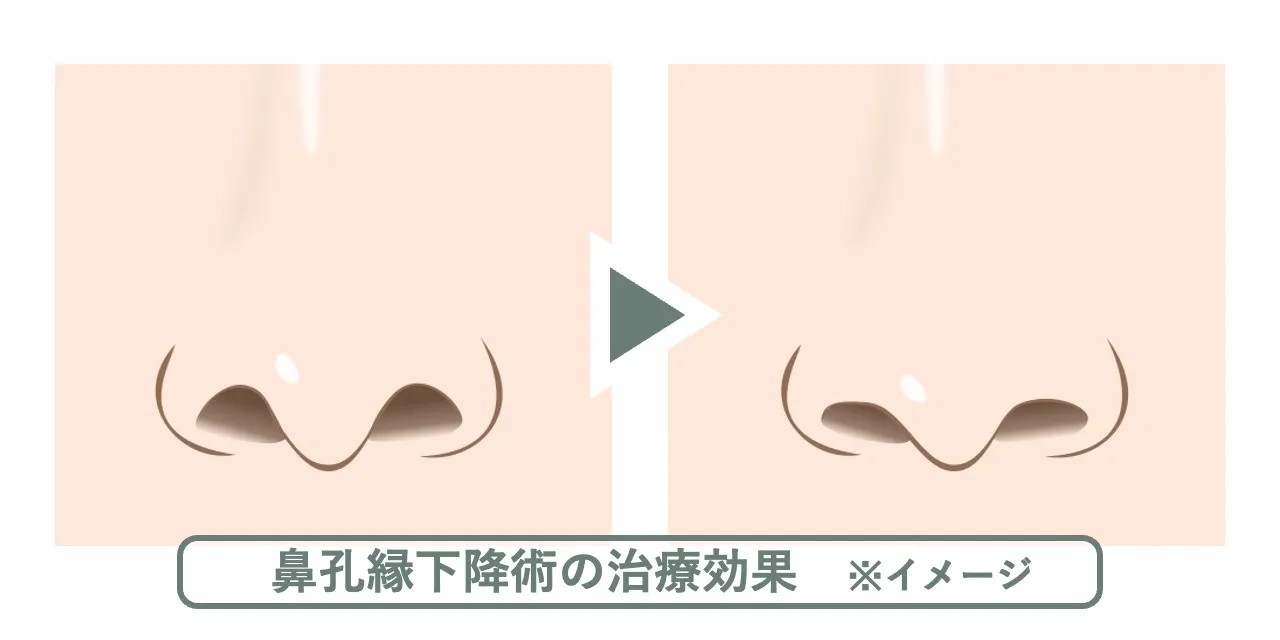 鼻孔縁下降術の効果・変化のイメージ