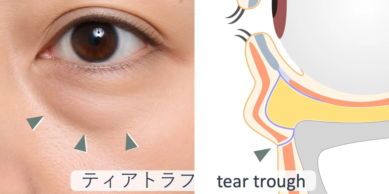 下まぶたのへこんだ線（ティアトラフ）の位置と、断面構造