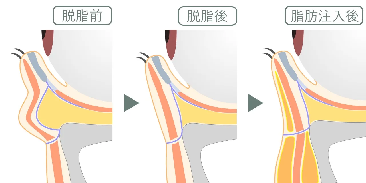 経結膜脱脂後に脂肪注入を行った場合の、下眼瞼断面のイメージ図