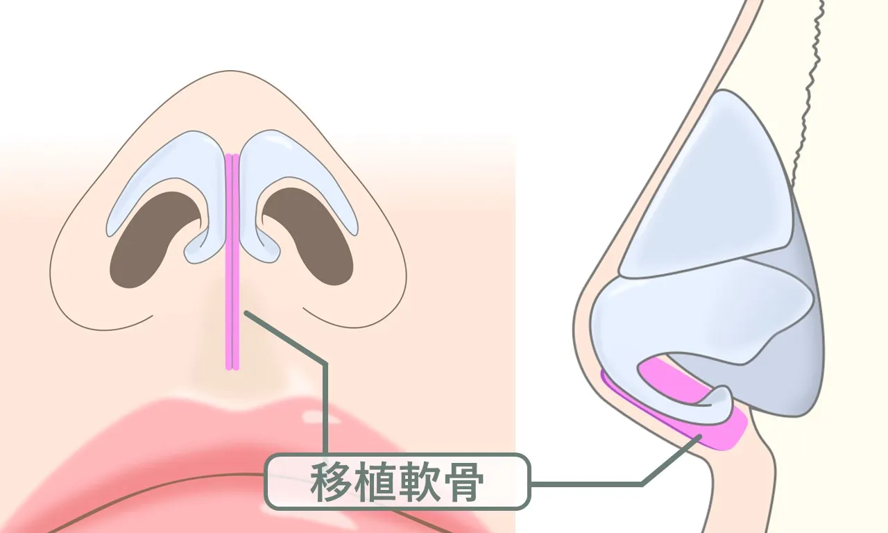 鼻柱軟骨移植における移植軟骨の固定位置