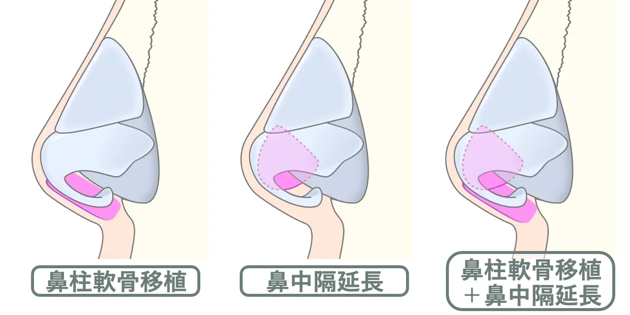 鼻柱軟骨移植と鼻中隔延長の軟骨移植位置の比較