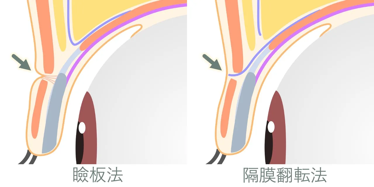二重切開法の、術式による傷あとの目立ちやすさの違い