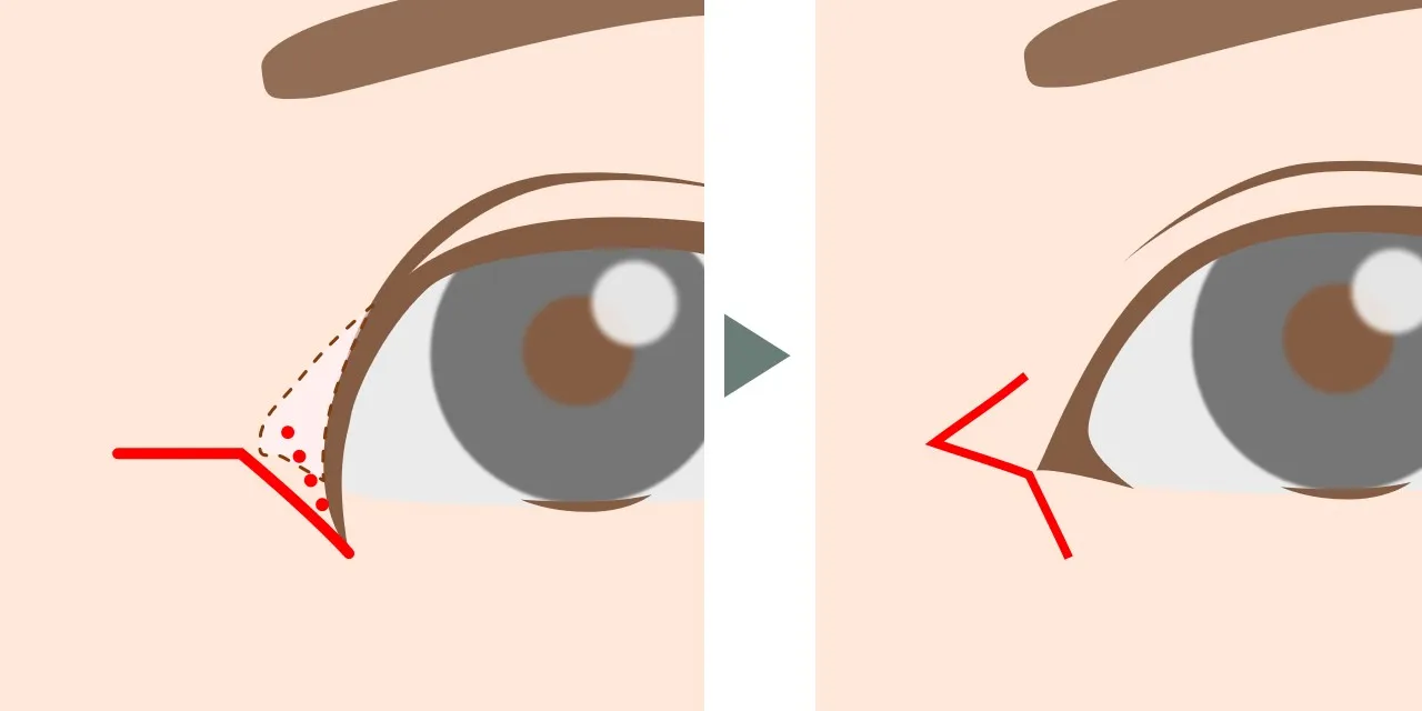 目頭切開(half-Z法)の手術デザインと、術後の傷あとの位置