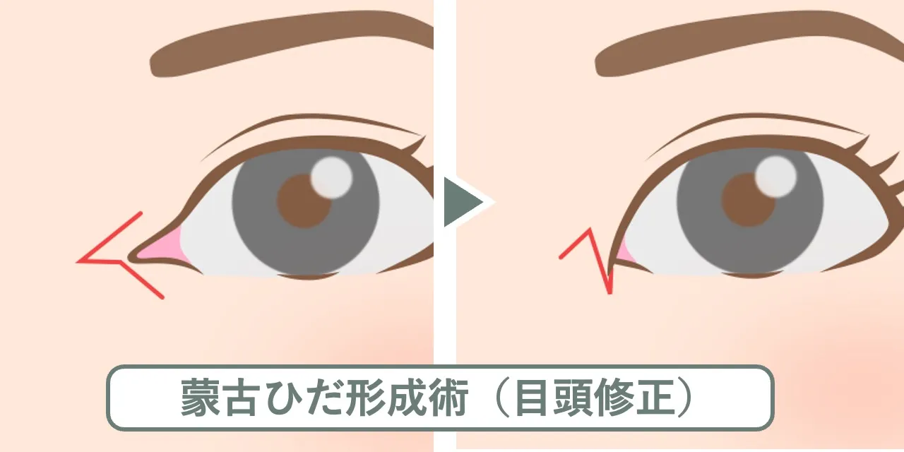 蒙古ひだ形成術（目頭修正）の切開線のデザインと、術前後の変化