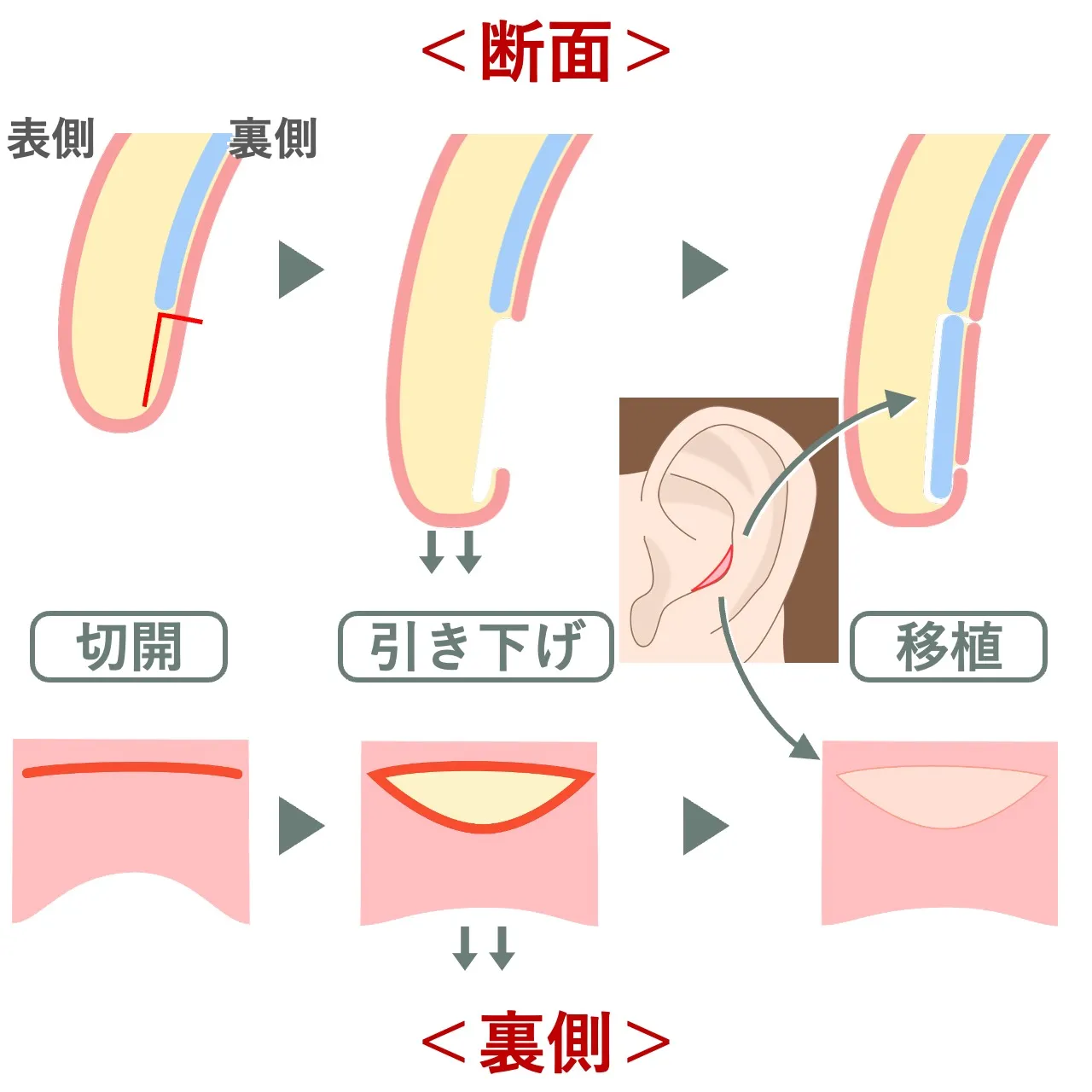 鼻孔縁下降術における鼻孔内への皮膚軟骨移植の詳細