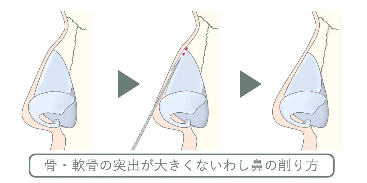 わし鼻手術の流れ|骨・軟骨の突出が軽い場合 は、ノミと骨ヤスリで平らにする