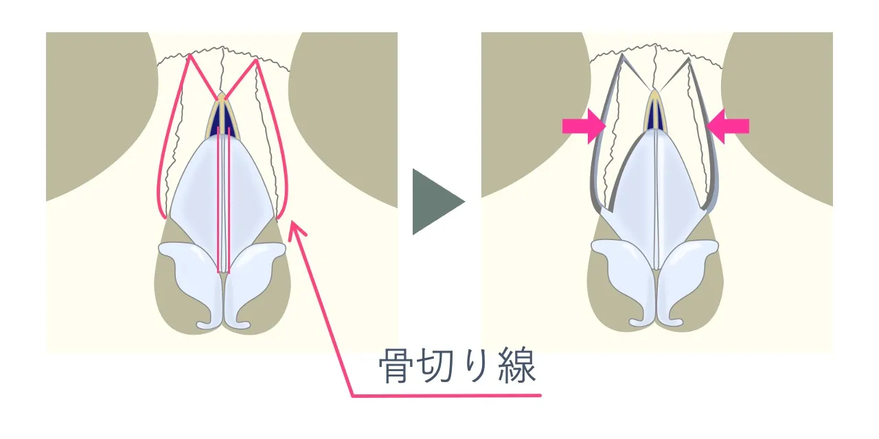 わし鼻修正|骨・軟骨の突出が強い場合の骨切のライン