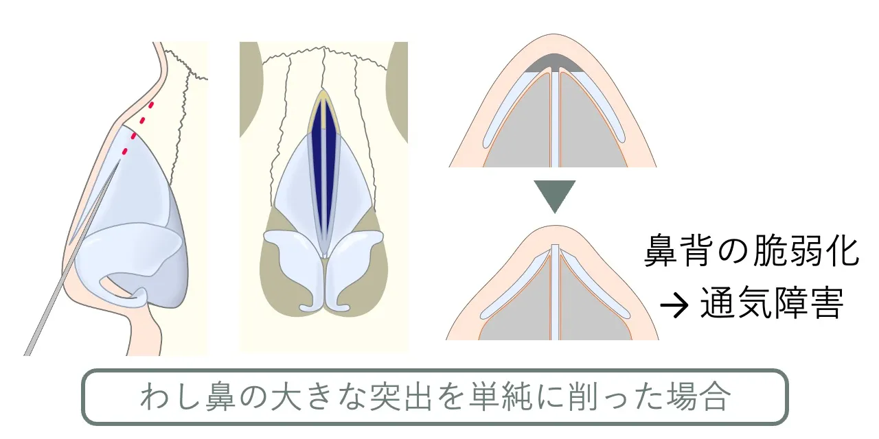 わし鼻修正の流れ|骨・軟骨の突出が強い場合はノミと骨ヤスリで単純に削ると通気障害をきたす