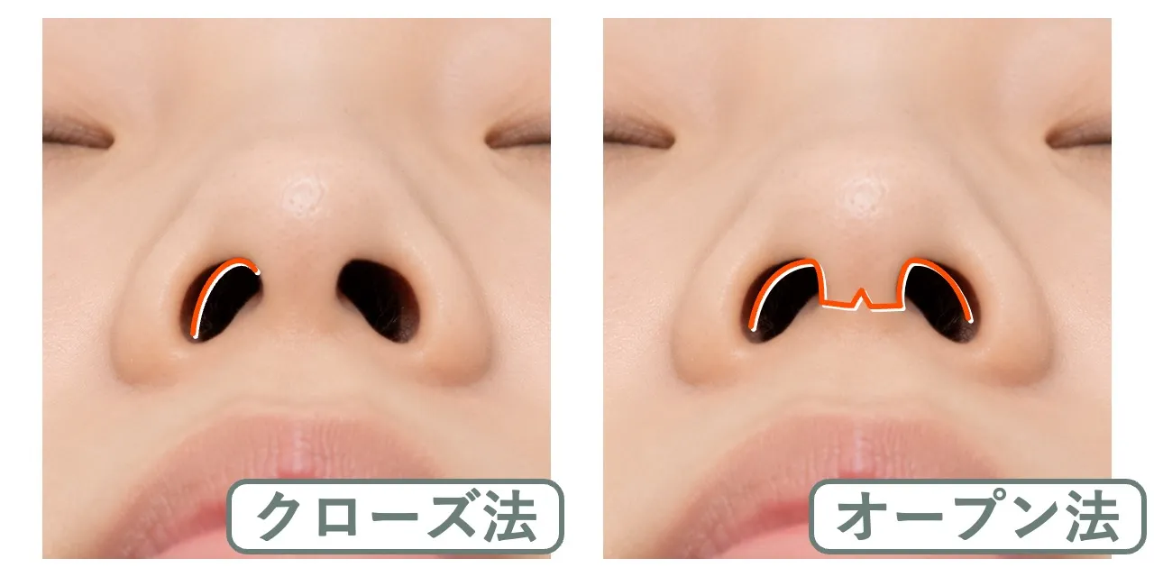 オープン法とクローズ法の切開位置の違い