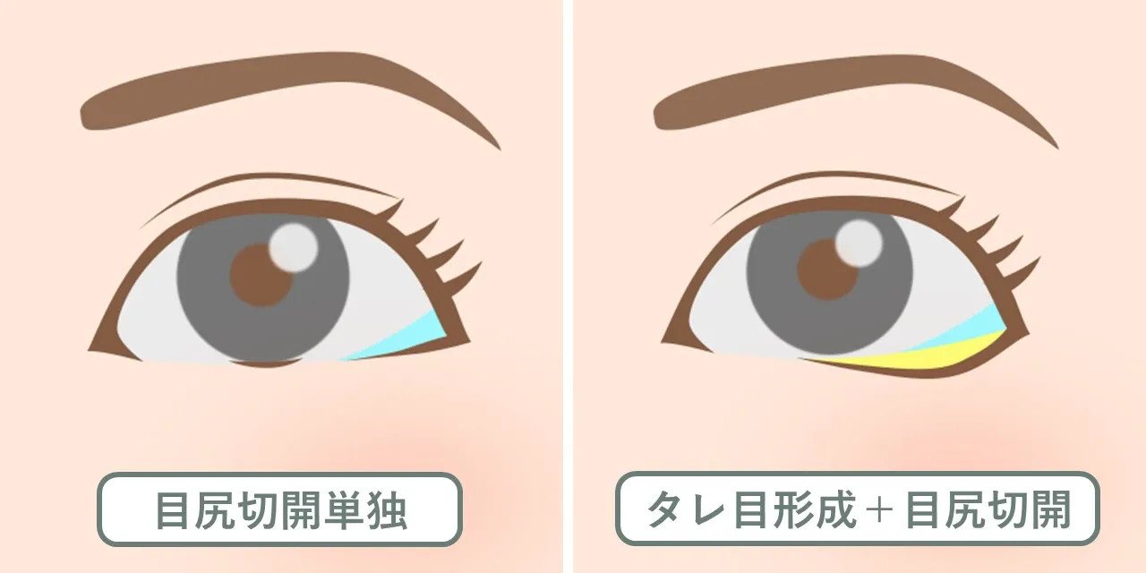 目尻切開単独手術と、目尻切開とタレ目形成を同時に行った場合の変化量の違い