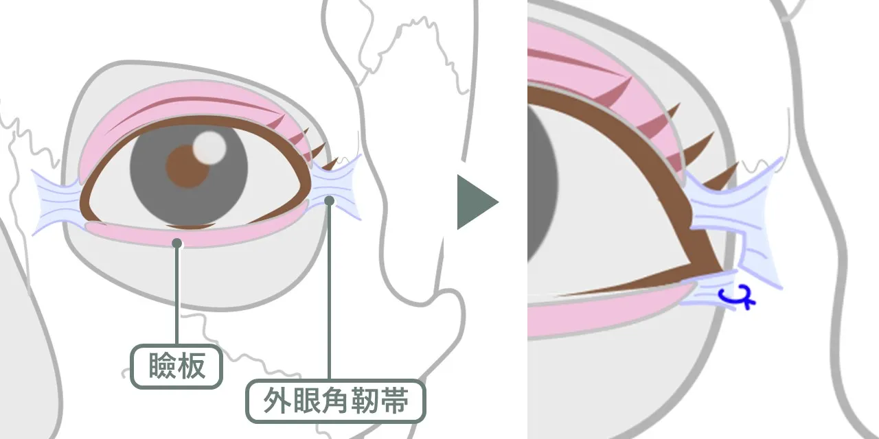 Chae法における外眼角靭帯の取り扱い。下眼瞼瞼板の外側端を一旦骨から切り離すので、大きな変化を出せる。