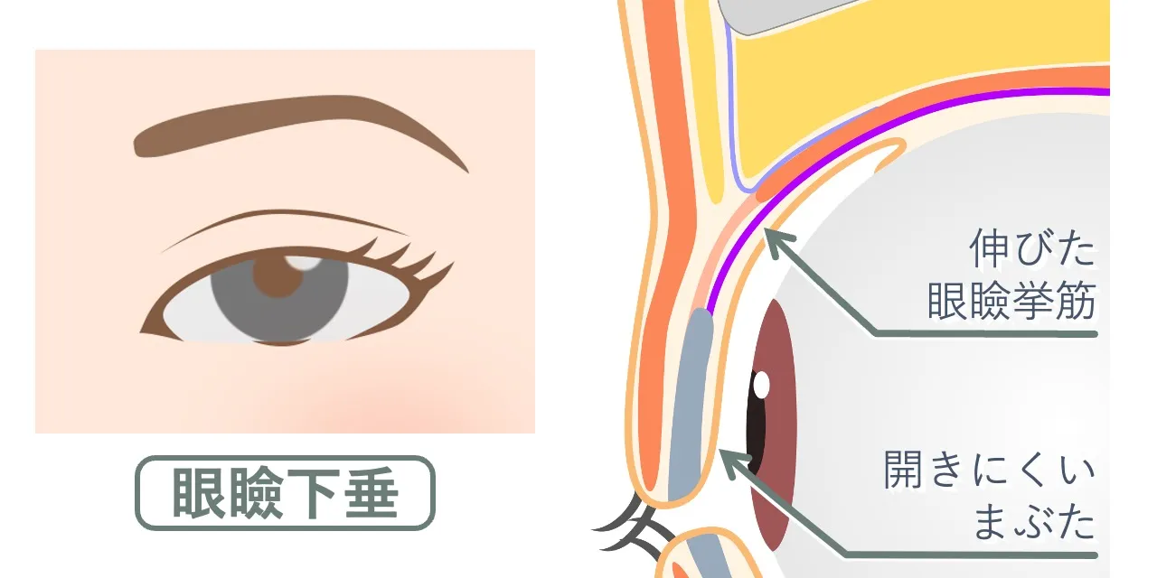 眼瞼下垂のある上眼瞼の断面解剖