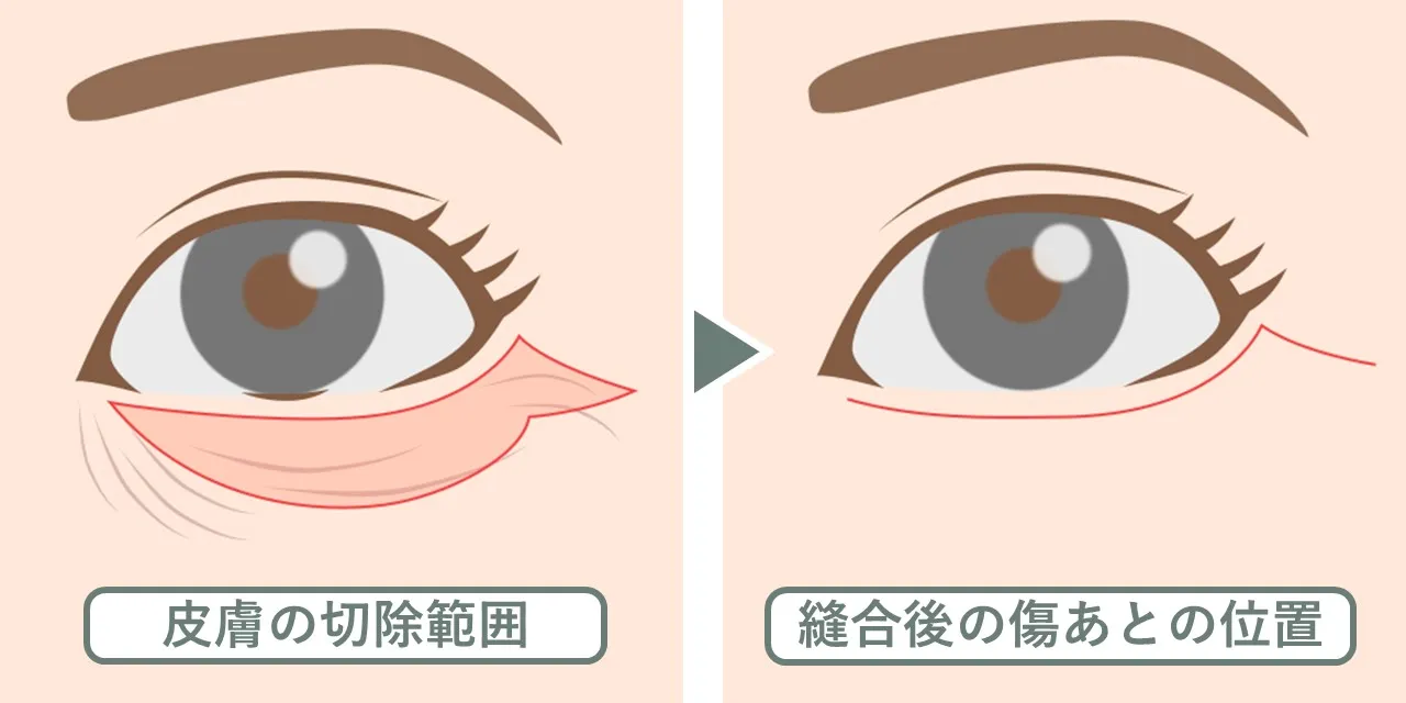 下まぶたのたるみ手術(下眼瞼除皺術)」の皮膚切除範囲と、縫合後の傷あとの位置