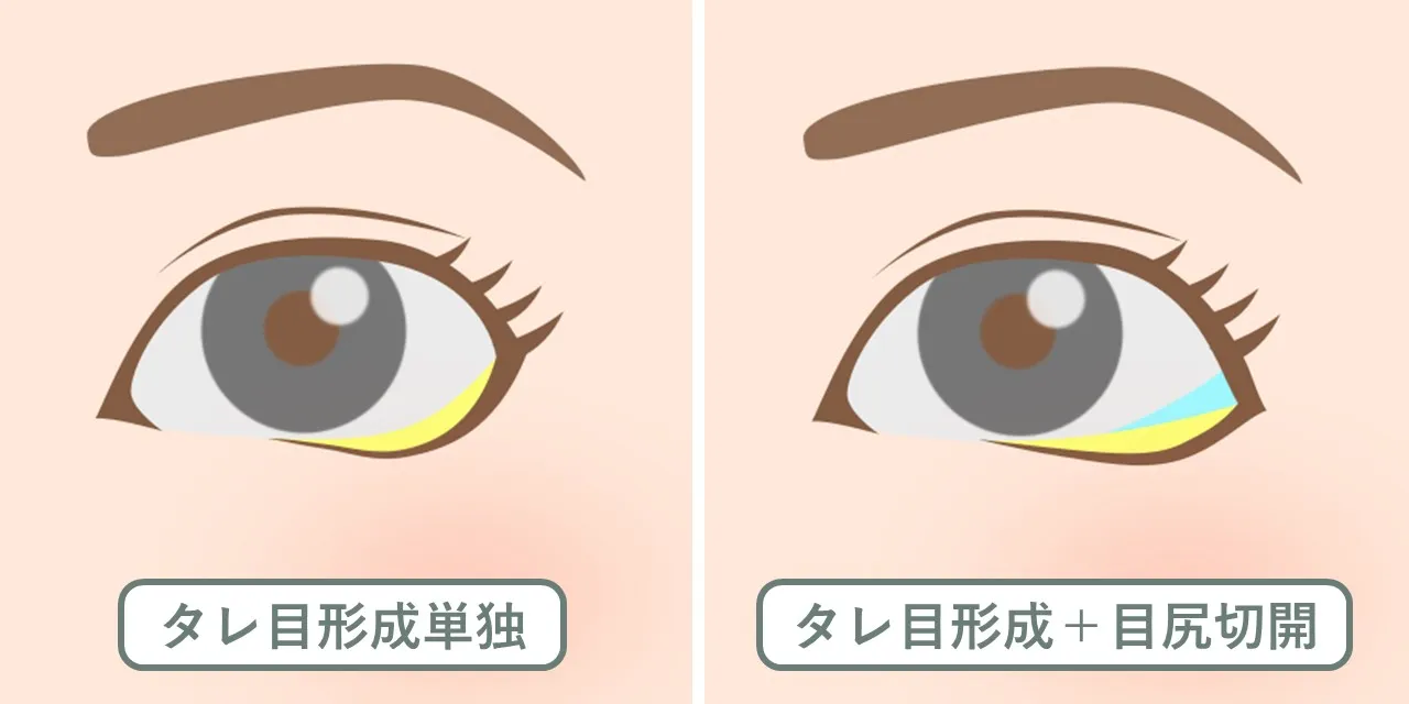 タレ目形成と目尻切開を同時に行ったときの変化のイメージ