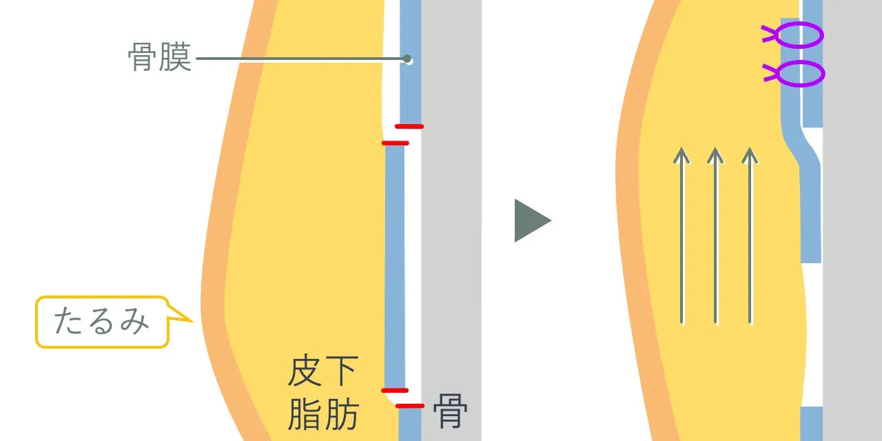 ミッドフェイスリフト（骨膜下リフト）で皮下組織のたるみを骨膜ごと引き上げ、骨膜同士を縫合固定するイメージ