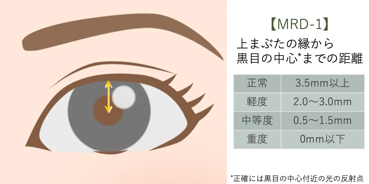眼瞼下垂の重症度を示すMRD-1の数値表。数値が小さいほどまぶたの下がりが強い