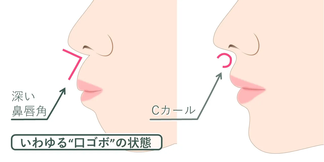 鼻唇角が奥まった「口ゴボ」と呼ばれる状態