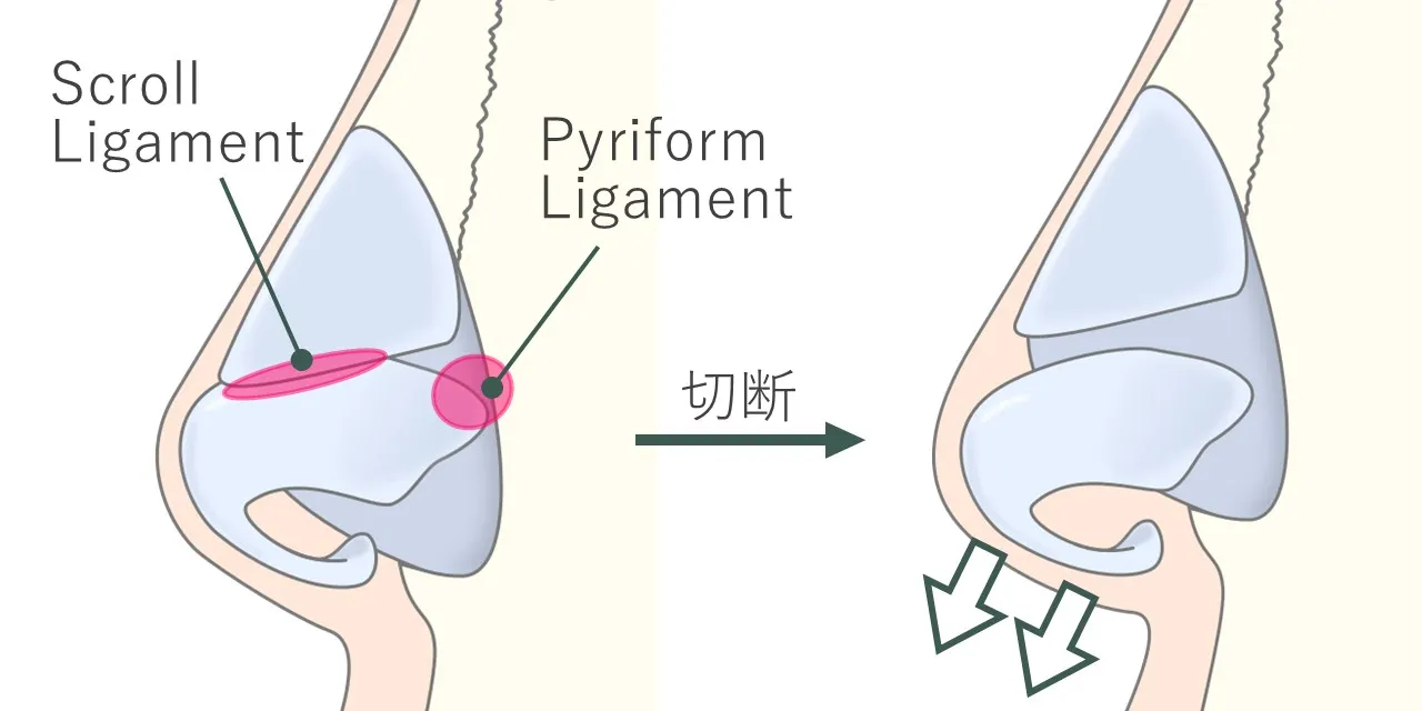 鼻中隔延長で鼻翼軟骨の可動性を得るには、scroll ligamentとpyriform ligamentを離断する必要があります