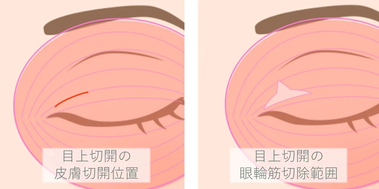 目上切開の皮膚切開の位置と、蒙古ひだの影響を軽減するために眼輪筋を切除する範囲