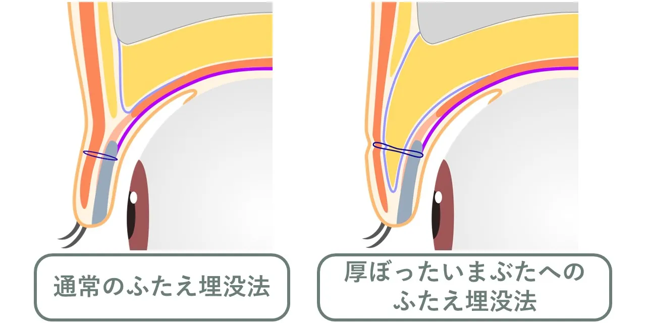 普通のまぶたと眼窩脂肪が重いまぶた、双方に二重埋没法を行った際のイメージ図。脂肪が多いと二重のラインより下に脂肪のボリュームがあり、重い二重になりやすい。