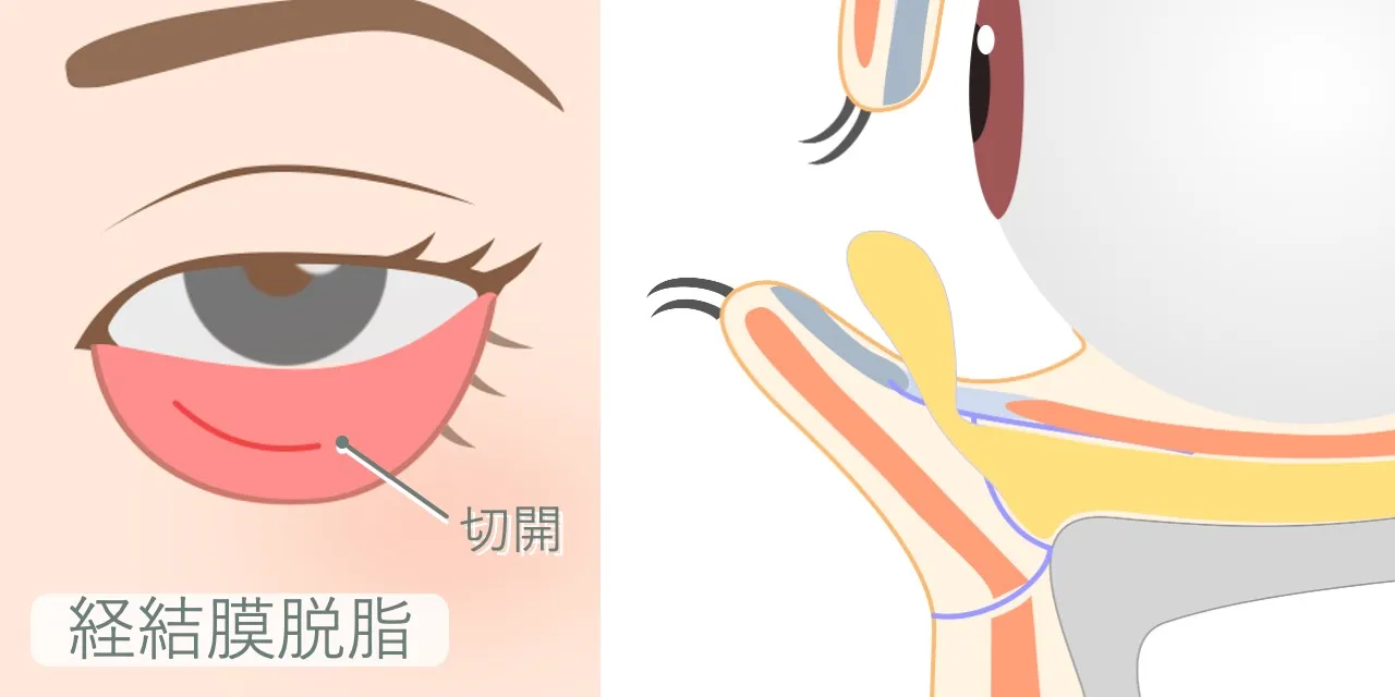経結膜脱脂（切らないクマ治療）の施術イメージ｜下まぶたの粘膜を切開し、余分な眼窩脂肪を取り除く様子