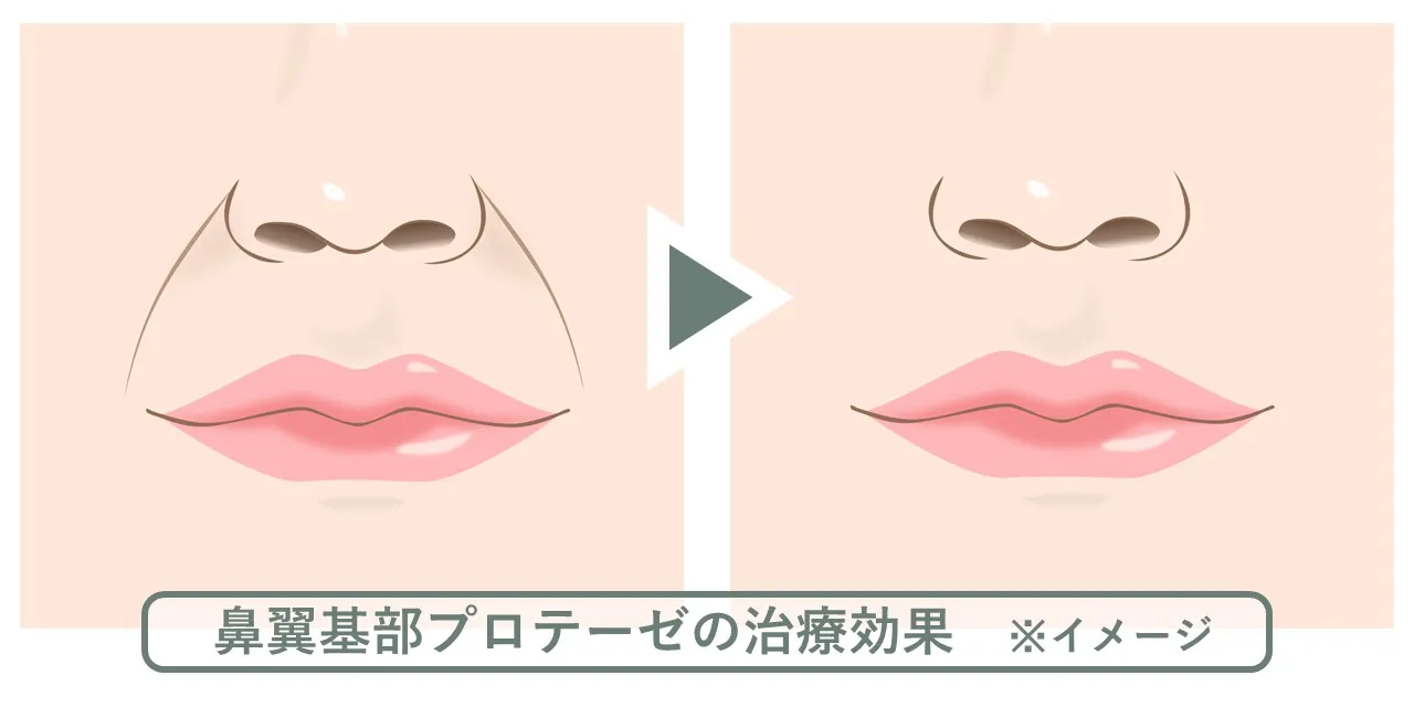 鼻翼基部プロテーゼによって小鼻横の凹みが緩和され、ほうれい線が目立たなくなる