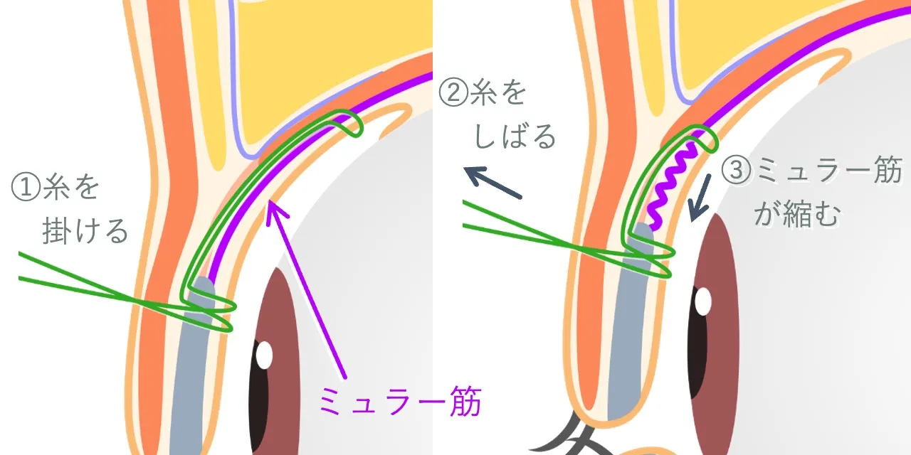 切らない眼瞼下垂手術（埋没式ミュラー筋短縮術）における、埋没糸の通し方と、糸の結紮によりミュラー筋が短縮される様子