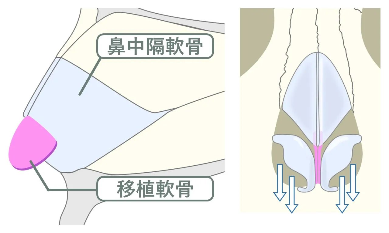 鼻中隔延長における移植軟骨のイメージ