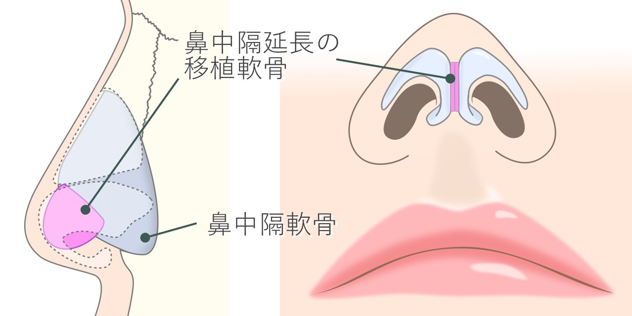 鼻中隔延長術における、鼻中隔軟骨と移植軟骨の位置関係