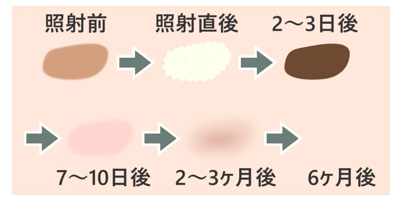 Qスイッチレーザー照射ごのシミの経過イメージ