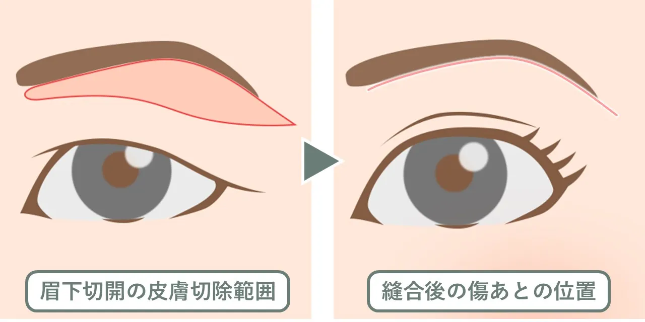 眉下切開の皮膚切除範囲と、縫合後の傷あとの位置