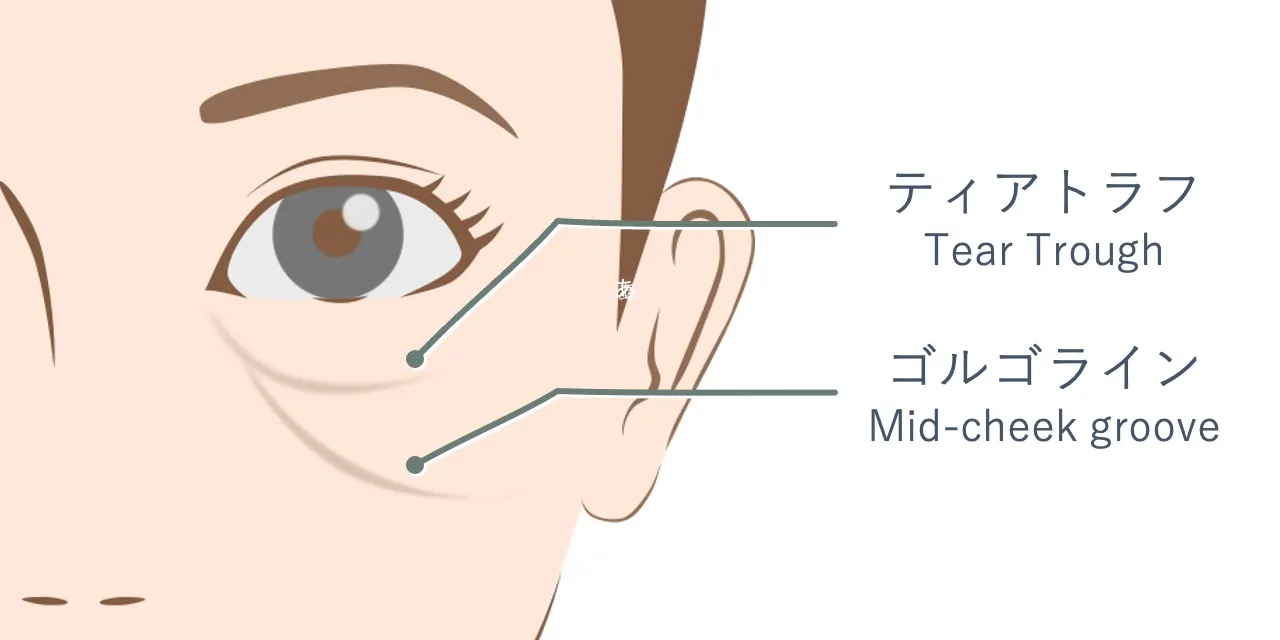 ゴルゴラインとティアトラフの位置関係